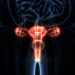 Mengenal Kanker Ginekologi dan Potensi Bahayanya Bagi Perempuan