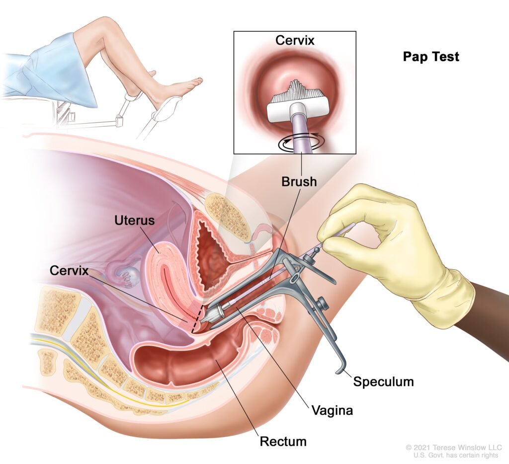 pap smear untuk mencegah kanker serviks